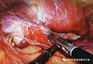 Left salpingostomy