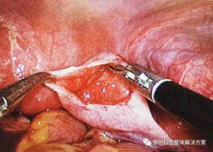 Right salpingostomy