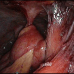 laparoscopy image