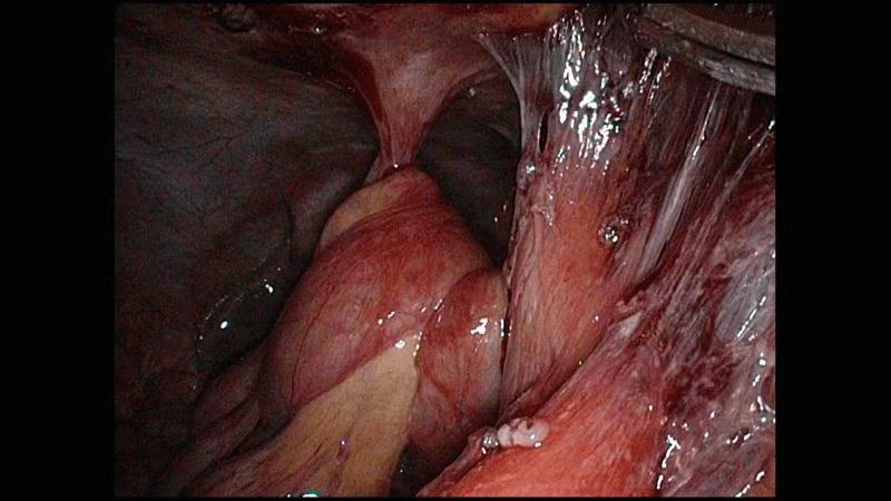 laparoscopy image